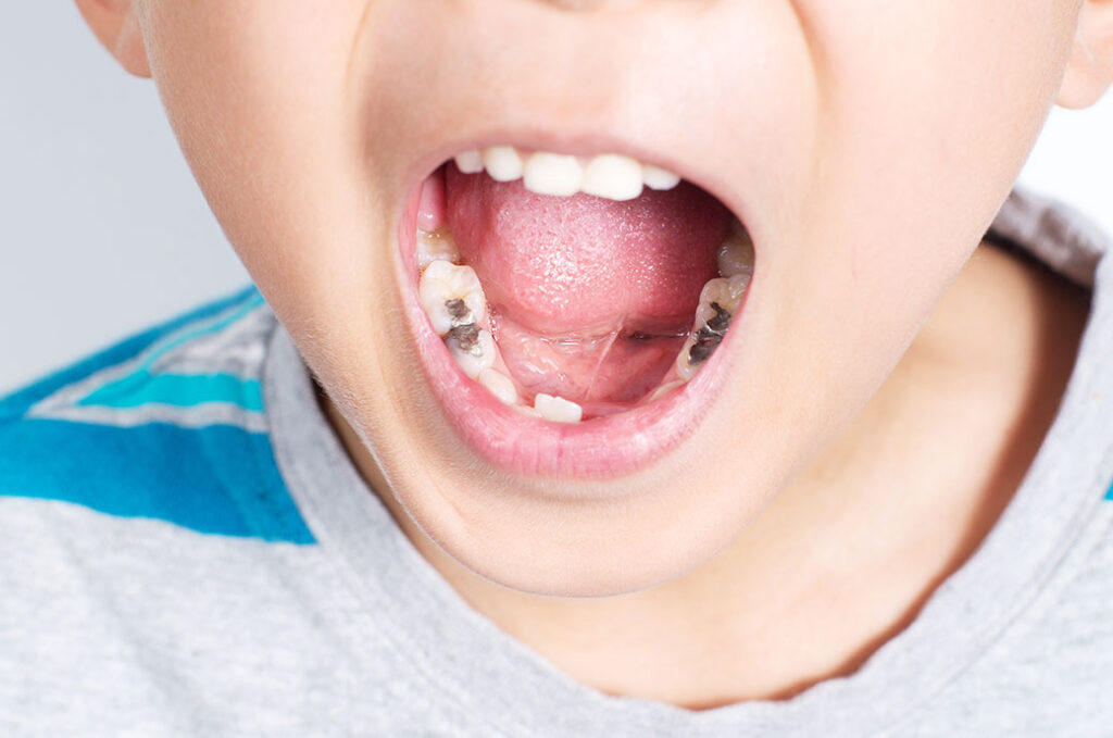 young boy with amalgam cavity fillings metamora il and central illinois